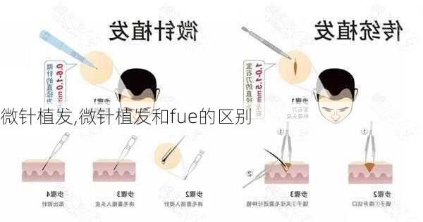 微针植发,微针植发和fue的区别